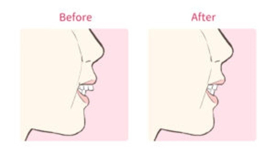 口を開いている横顔の比較図