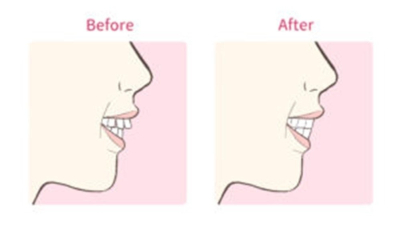 笑っている横顔の比較図