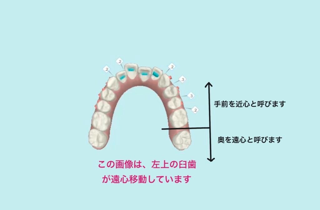 インビザライン矯正治療における遠心移動について | マウスピース矯正