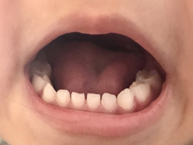 乳歯列の子供の口